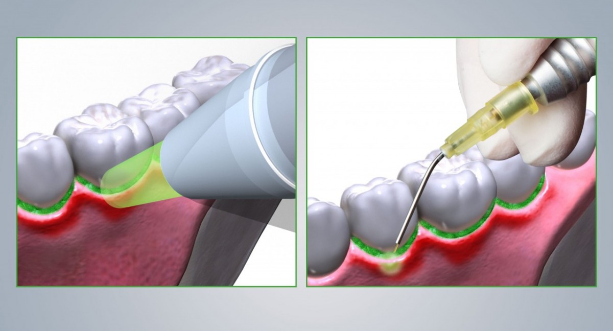 Moderne Parodontitistherapie Mit EmunDo® - Dentabellion